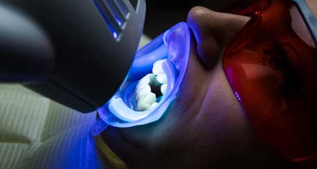How Does Laser Teeth Whitening Work